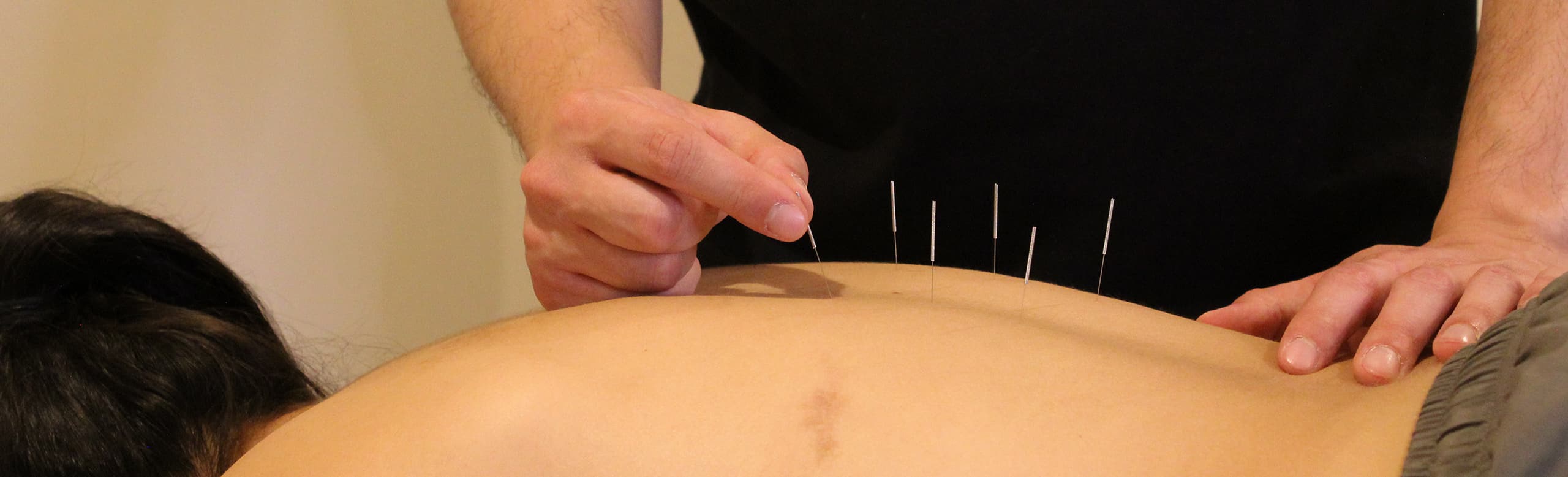 Person receiving acupuncture treatment at ROOT Physio physiotherapy services London.