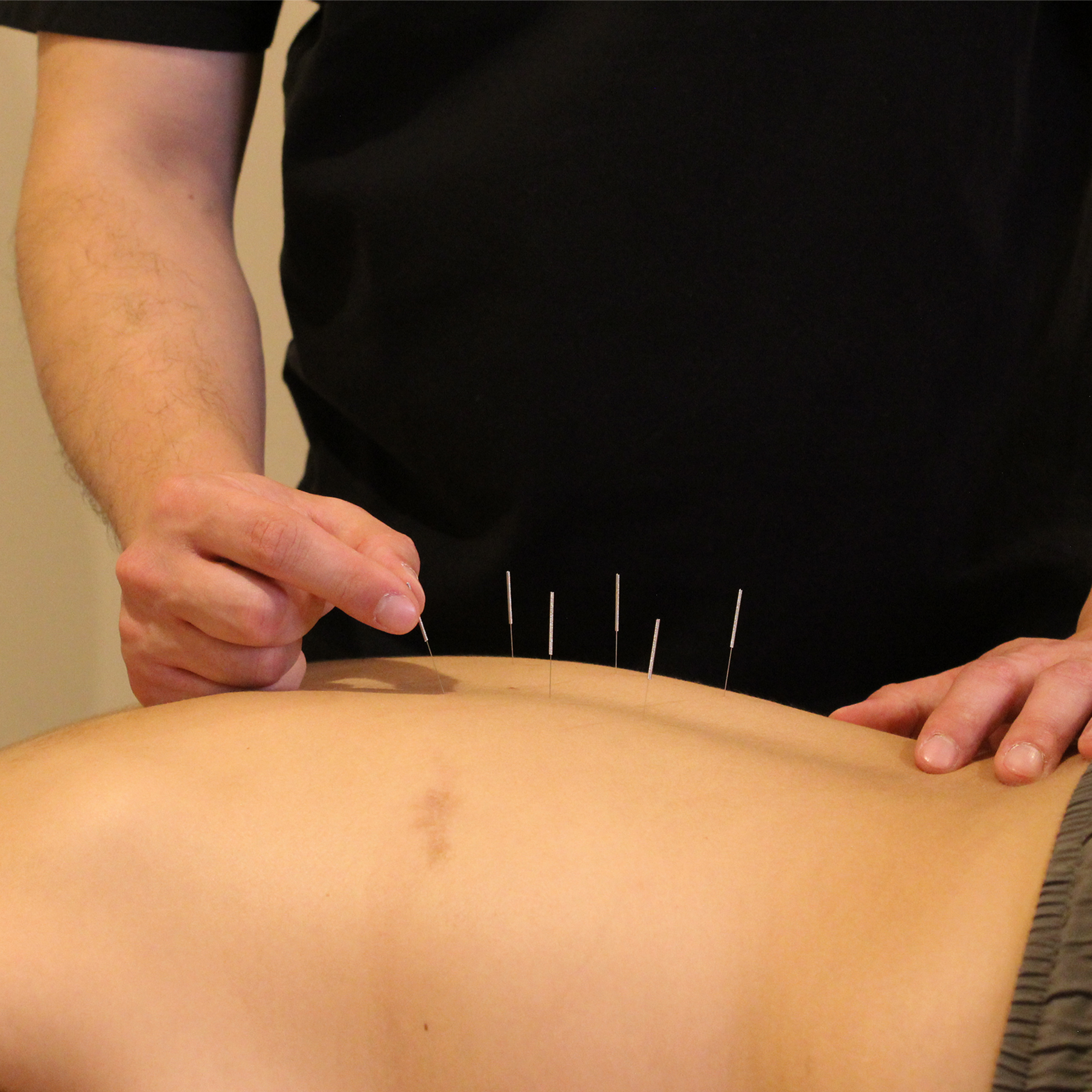 Person receiving acupuncture treatment at ROOT Physio physiotherapy services London.